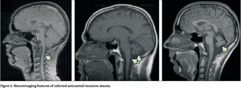 How Friedreich's Ataxia affects the nervous system
