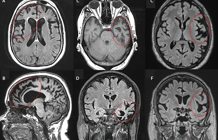 Key differences between FTD vs Alzheimer's