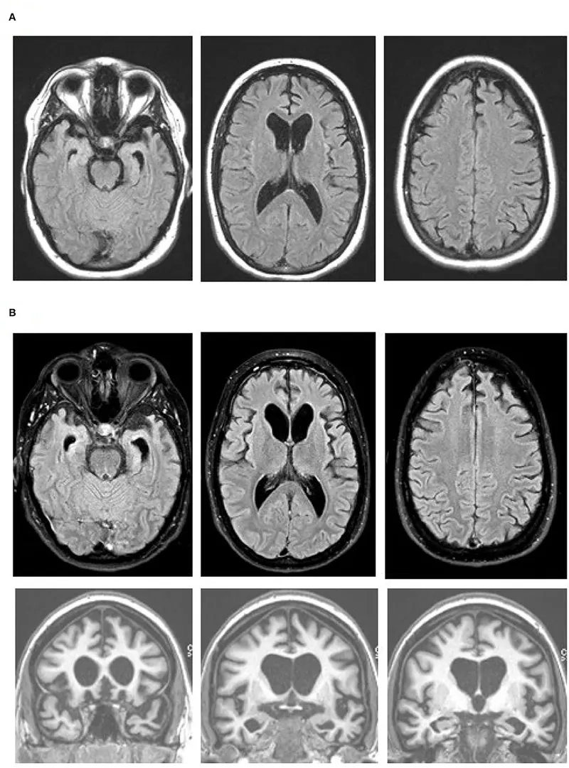 A visual guide to the stages of FTD