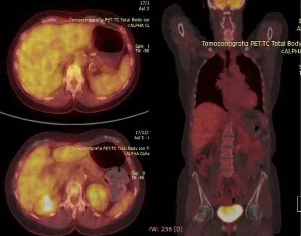 Infographic on gallbladder cancer stages