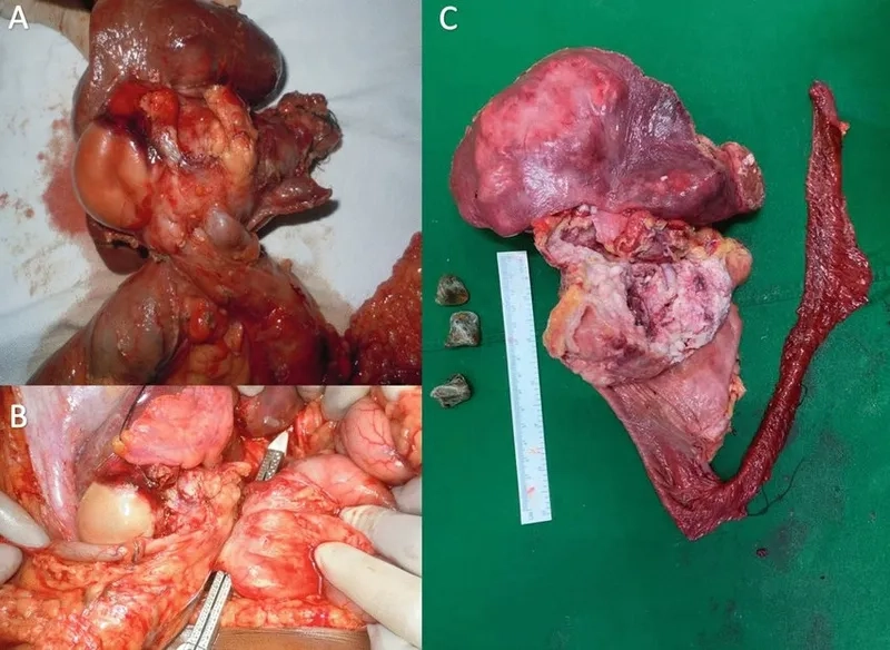 Doctor discussing gallbladder cancer treatment options