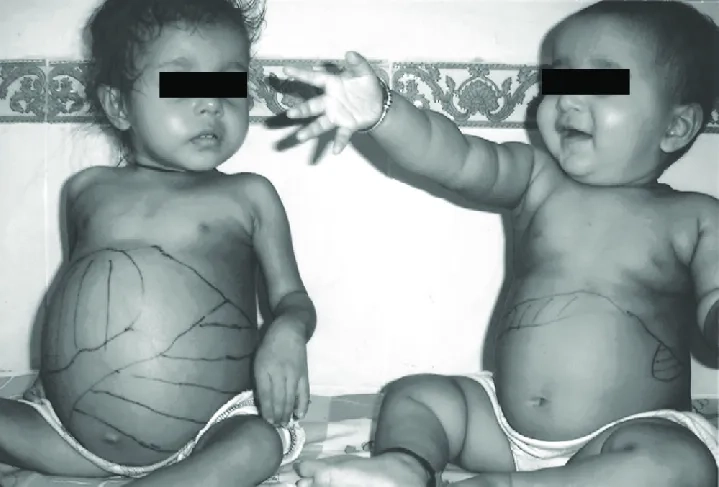 What is gaucher disease and medical overview