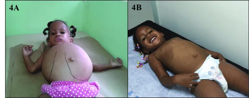 Gaucher disease treatment and care approaches