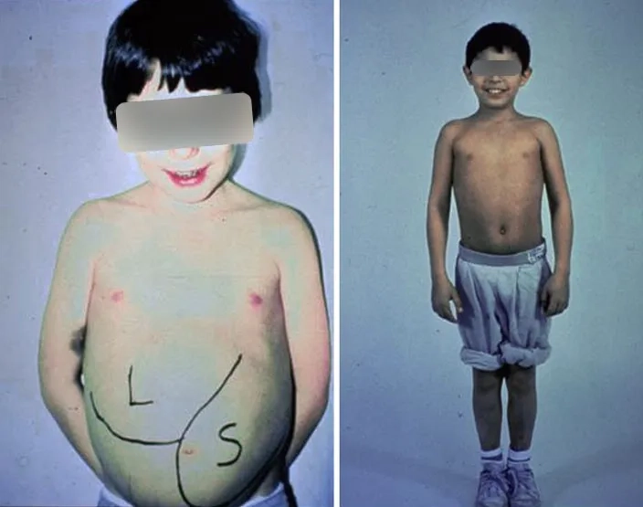 Gaucher disease inheritance and genetic pattern