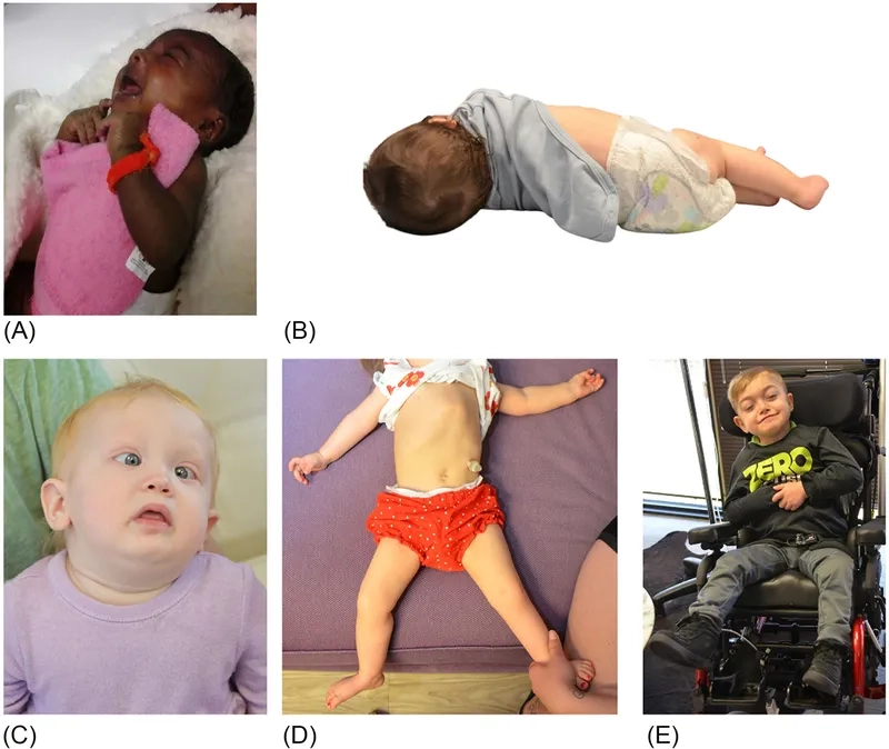 Gaucher disease diagnosis and clinical evaluation