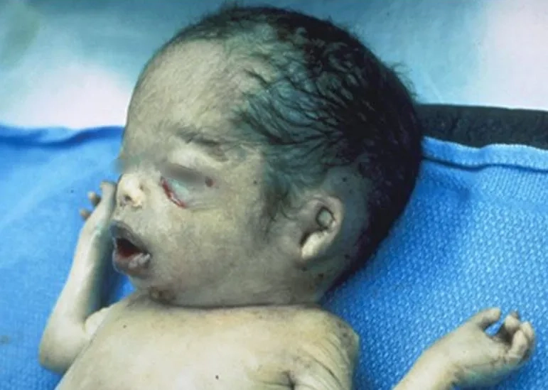 Gaucher disease causes and risk factor insights