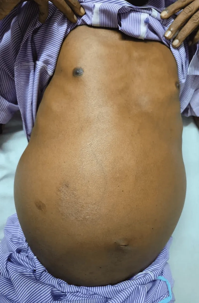 Enzyme replacement therapy for gaucher disease