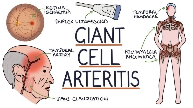 Temporal arteritis as a serious vascular condition