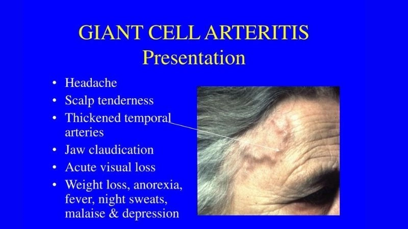Symptoms of giant cell arteritis to recognize early