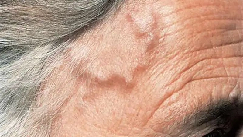 Giant cell arteritis and vision loss risk warning