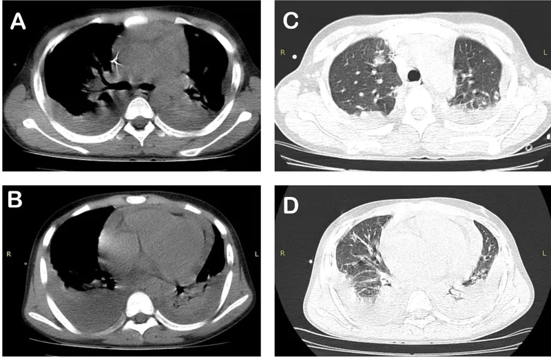 A visual guide to glanders disease symptoms