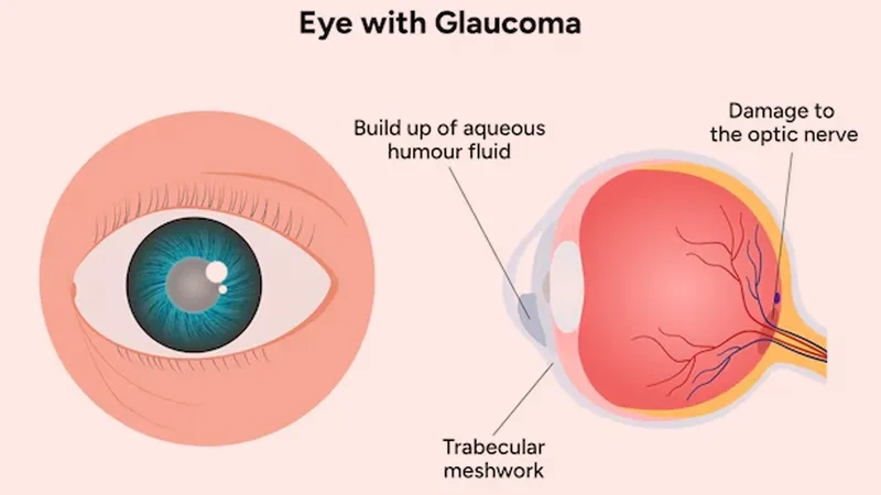 The risks if glaucoma is not treated