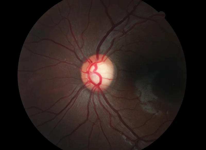 Explaining whether you can catch glaucoma