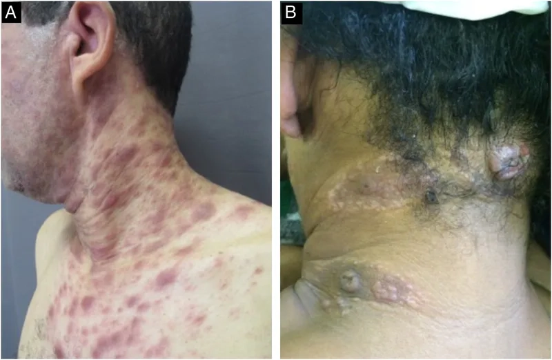 Is gonorrhea curable? Get the facts