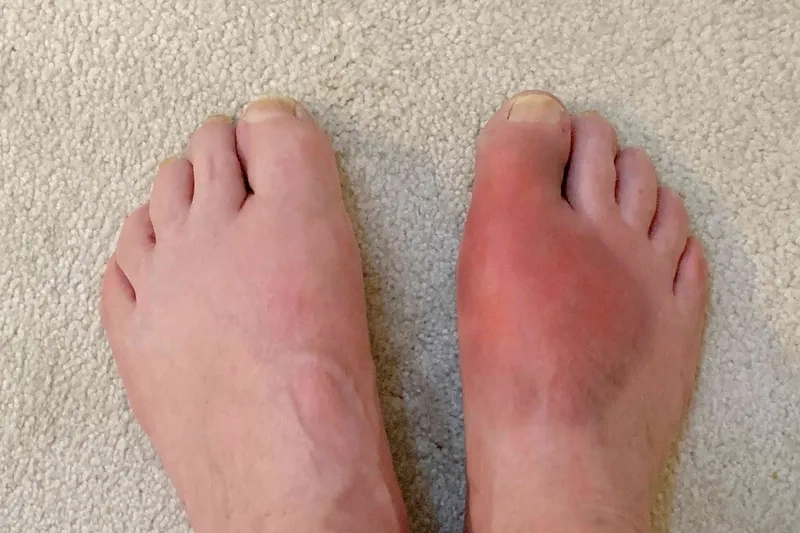 Gout symptoms causing joint pain and swelling