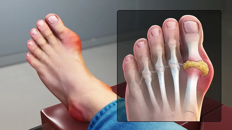 What causes gout and uric acid buildup