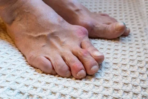 Gout flare up with sudden joint discomfort