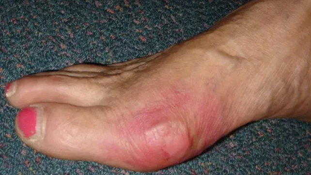 Colchicine for gout flare control and relief