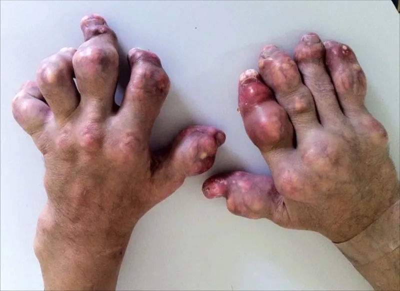 Gout in big toe with redness and pain