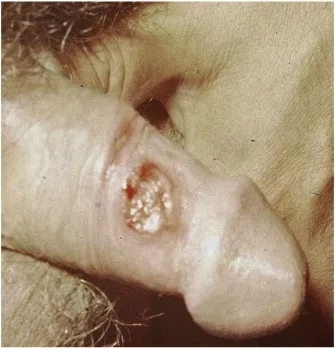 Doctor assessing if cutaneous granulomas are dangerous