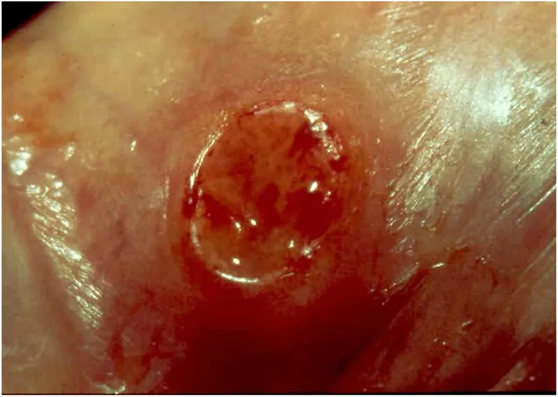 A patient's skin showing that some granulomas are itchy