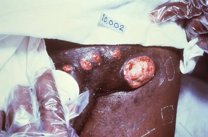 Medical chart confirming granuloma inguinale is curable