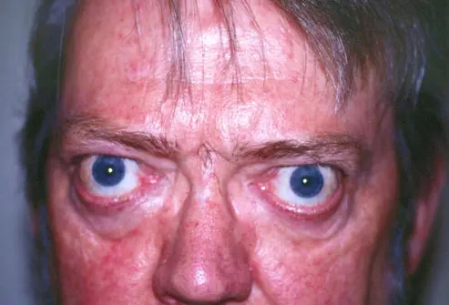 An illustration showing the effects of thyroid eye disease