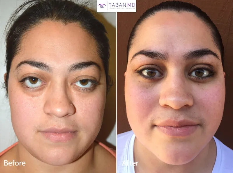 Understanding the mechanism of an autoimmune thyroid disease