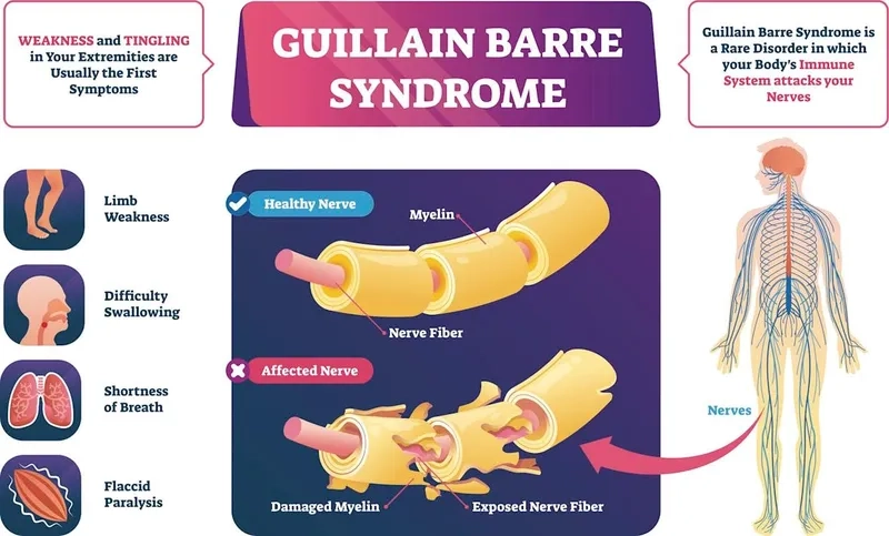 A timeline of Guillain-Barré syndrome symptoms progression
