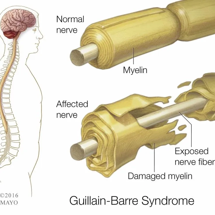 Comparing GBS and chronic inflammatory demyelinating polyneuropathy (CIDP)
