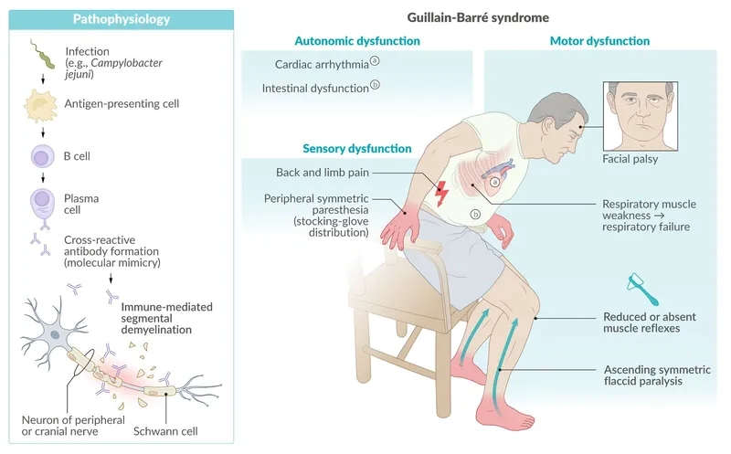 A diagram showing Guillain-Barré syndrome symptoms