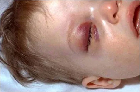 A child showing symptoms of Hib disease