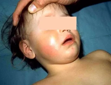 Brain scan indicating Hib meningitis