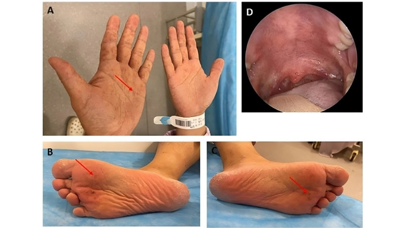The hand foot and mouth disease virus strain