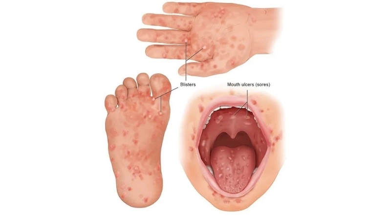 A typical hand foot and mouth disease rash