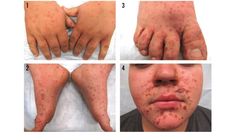 Symptoms of adult hand foot and mouth disease