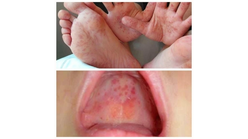 So, can adults get hand foot and mouth disease