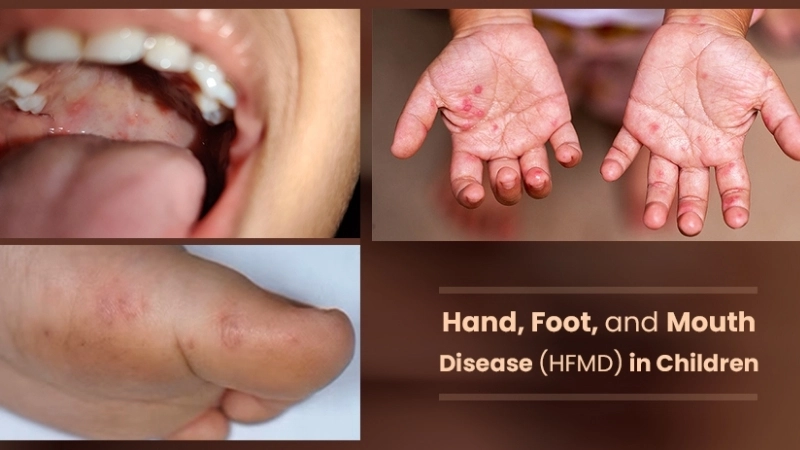 Signs of hand foot and mouth disease in a newborn