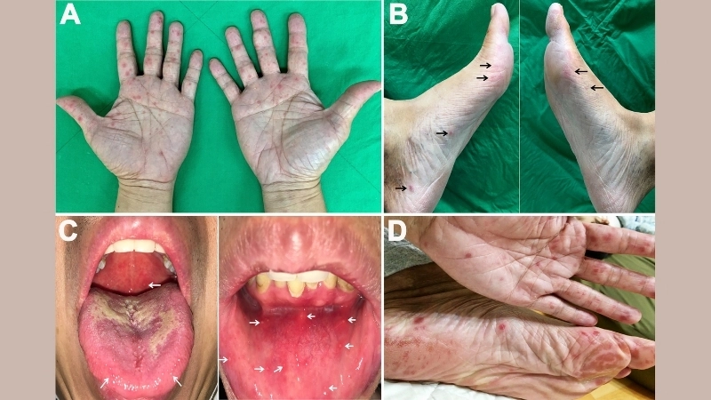 A viral infection: hand foot and mouth disease