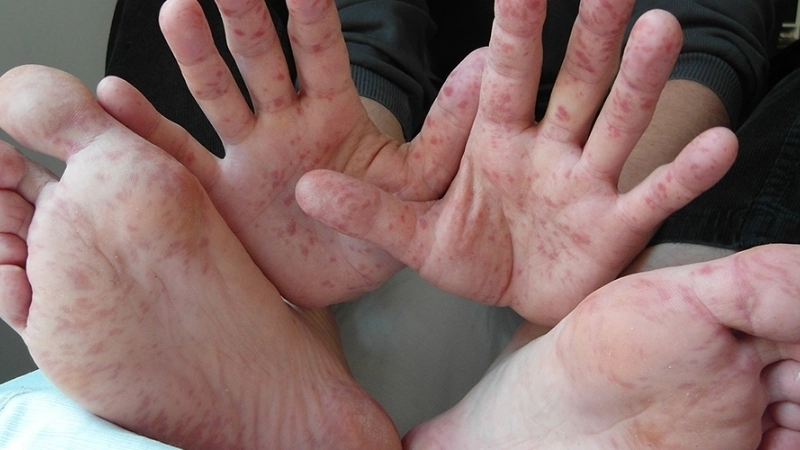 HFMD meningitis affects children with CNS symptoms