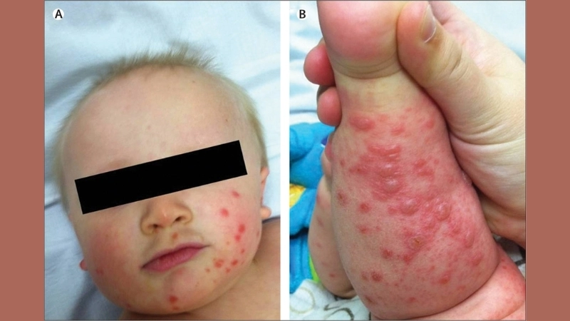 Pediatric encephalitis can be caused by HFMD viruses
