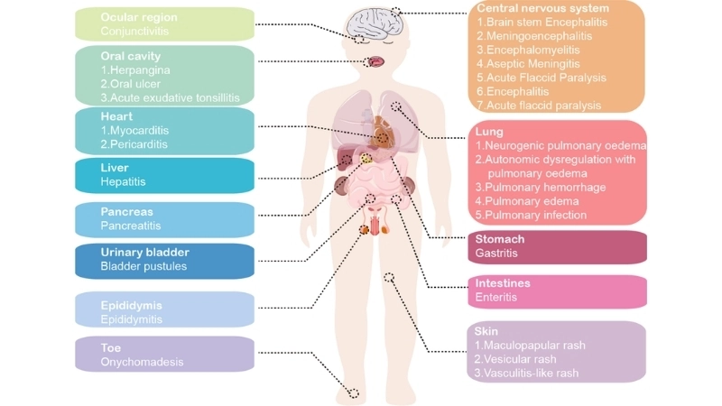 Neurological complications of HFMD need careful care