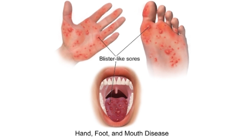 HFMD and brain damage may result from severe infection