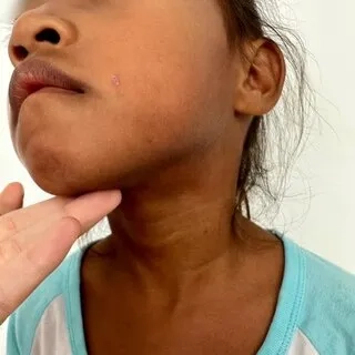 A lab result showing high TPO antibodies