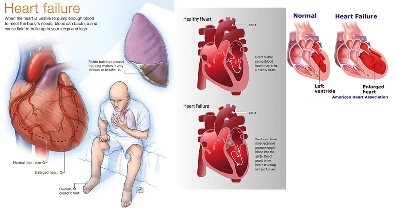 Diastolic heart failure illustration