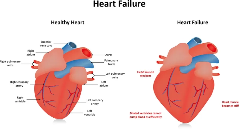 Diastolic heart failure illustration