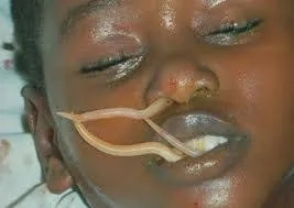 The process of deworming for humans