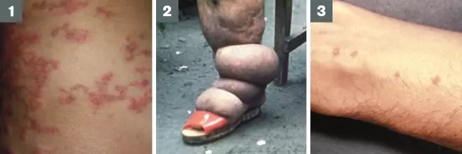 A patient showing symptoms of intestinal worms