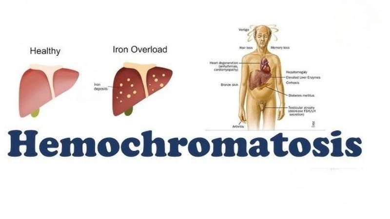 Hidden danger of iron overload cardiomyopathy