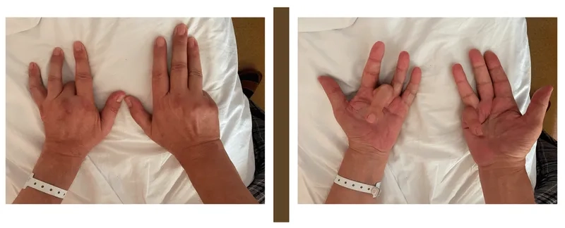 Phlebotomy therapy for hemochromatosis patients